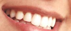 implantes-dentarios-campo-belo-1387299293